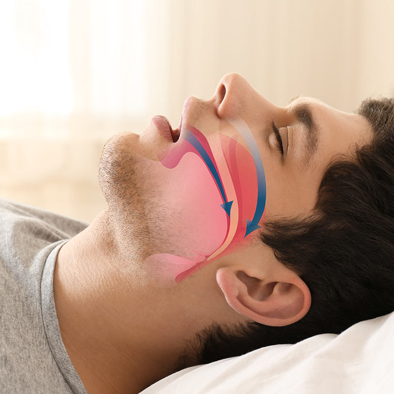 Sleep Apnea in Denham Springs, LA | Anderson Strickland Dental<br />
